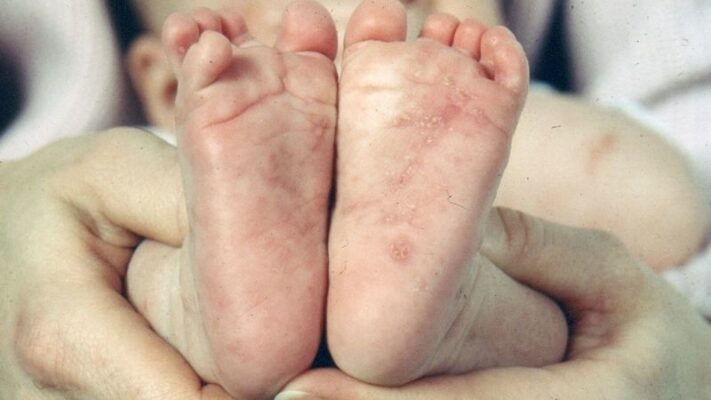 Bé đi giày bị mẩn đỏ chân